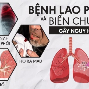 benh-lao-phoi-nguyen-nhan-trieu-chung-chan-doan-va-dieu-tri