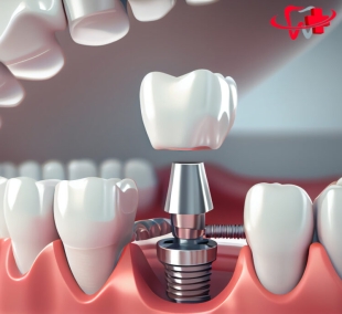 Cấy Ghép Implant